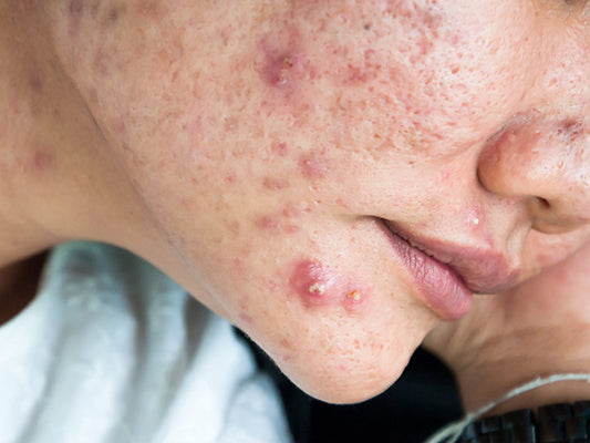What Is Cystic Acne And How Do You Treat It?