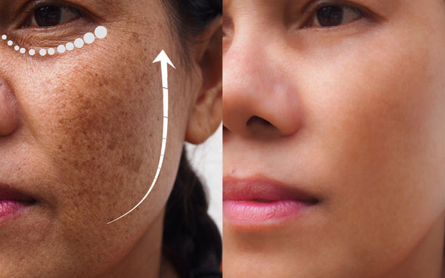 Kojic Acid: Your Ultimate Solution To Skin Pigmentation – SkinKraft