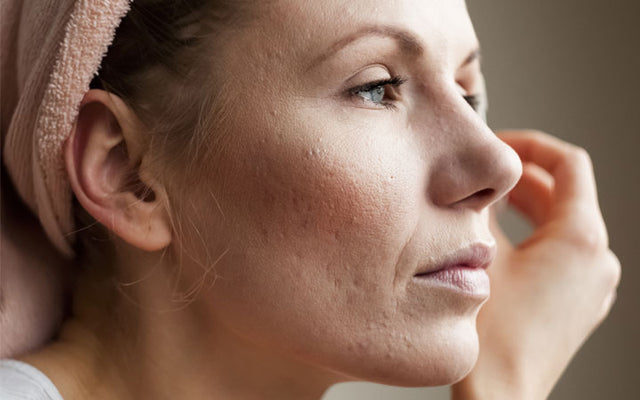 How To Treat Pockmarks On Your Face?