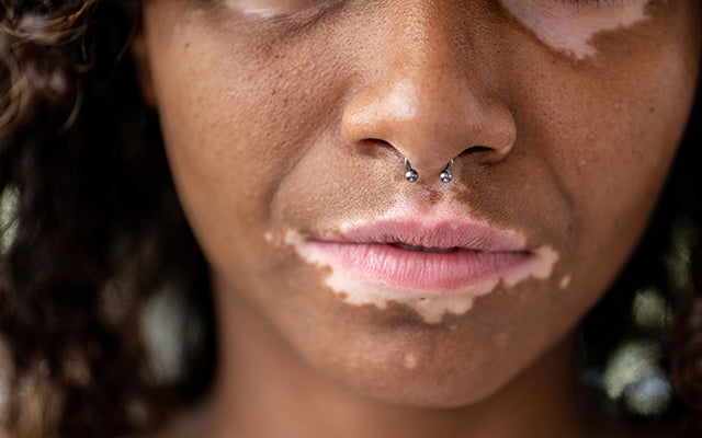 Vitiligo On Lips – Causes, Treatments & Useful Tips – SkinKraft