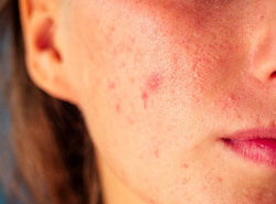 Acne Papules - Causes, Symptoms, Treatments