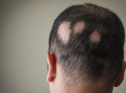 Alopecia Areata - Here’s Everything You Should Know About It