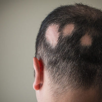 Alopecia Areata - Here’s Everything You Should Know About It