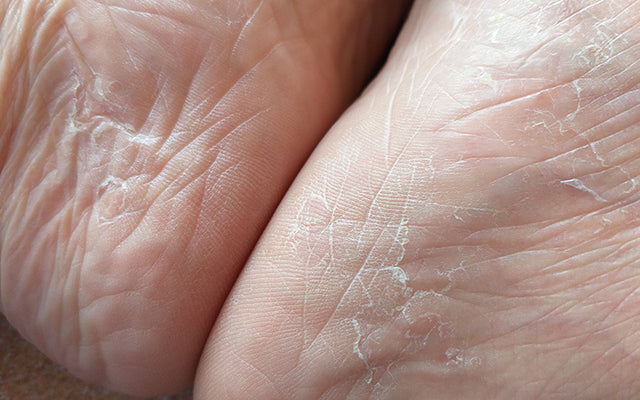 What Is Ashy Skin - Symptoms, Causes & 6 Ways To Treat It – SkinKraft