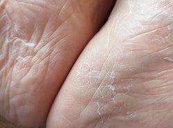 What Is Ashy Skin - Symptoms, Causes & 6 Ways To Treat It