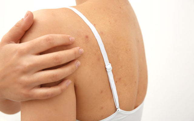 Back Acne: 6 Causes, 11 Treatments & 16 Prevention Tips