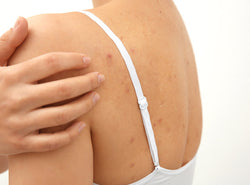 Back Acne: 6 Causes, 11 Treatments & 16 Prevention Tips