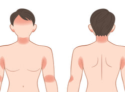 What Is The Difference Between Dermatitis & Eczema?