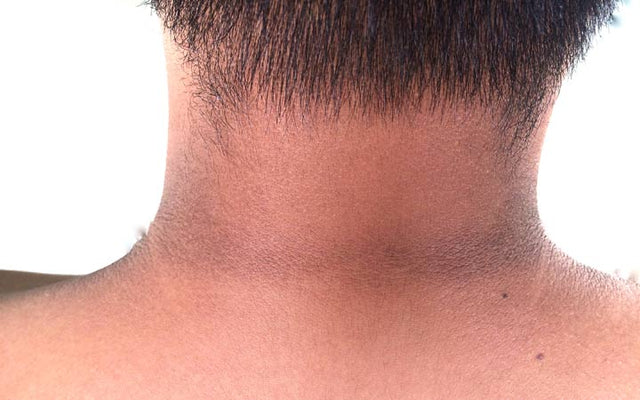 Dark neck: Why does skin pigmentation happen and what to do | HealthShots