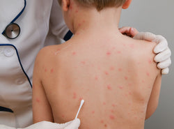 How To Remove Chickenpox Scars Easily?