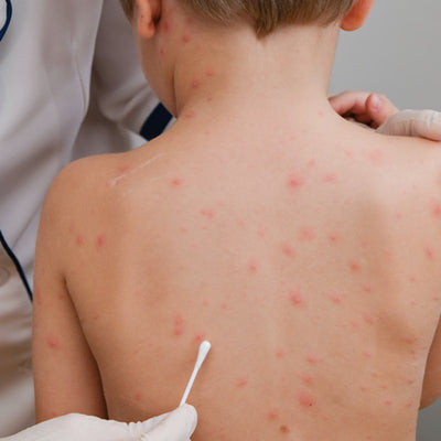 How To Remove Chickenpox Scars Easily?