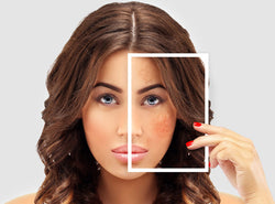 How To Get Rid Of Hyperpigmentation Acne