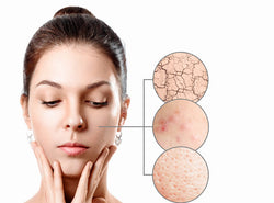 Dry Skin And Acne: Are You Treating It The Right Way?