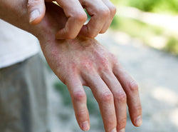 Psoriasis Vs. Eczema - How To Diagnose Your Skin Condition Correctly?