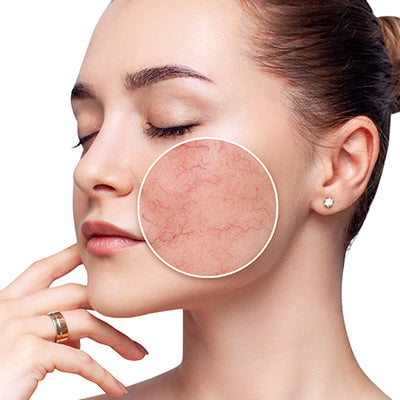 सेंसिटिव स्किन (संवेदनशील त्वचा) की देखभाल - Sensitive Skin Care Tips In Hindi