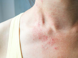 Skin Rash: An Emerging Symptom of Covid-19?