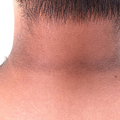 गर्दन के कालेपन को दूर करने के लिए उपाय - Remedies To Get Rid Of Dark Neck
