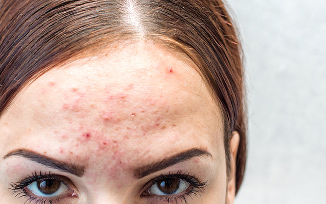 How To Treat Facial Acne Caused By Dandruff?