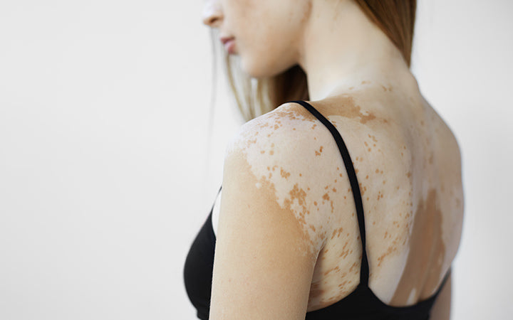 Low Pigmentation What Is Hypopigmentation And How To Treat It – SkinKraft