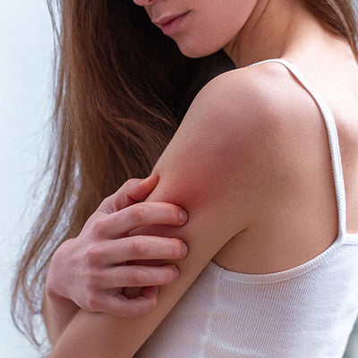 एक्जिमा यानी खुजली के लक्षण, कारण और  घरेलू इलाज - Eczema In Hindi