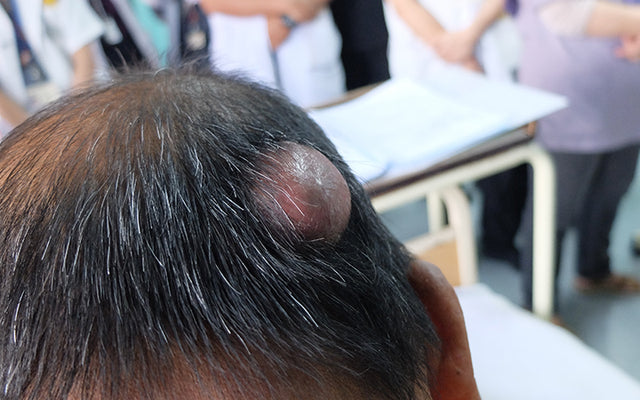 How Can You Control Pilar Cysts On Your Scalp?