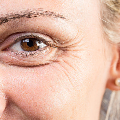 Crow’s Feet Around The Eyes: Causes, Treatment And Prevention