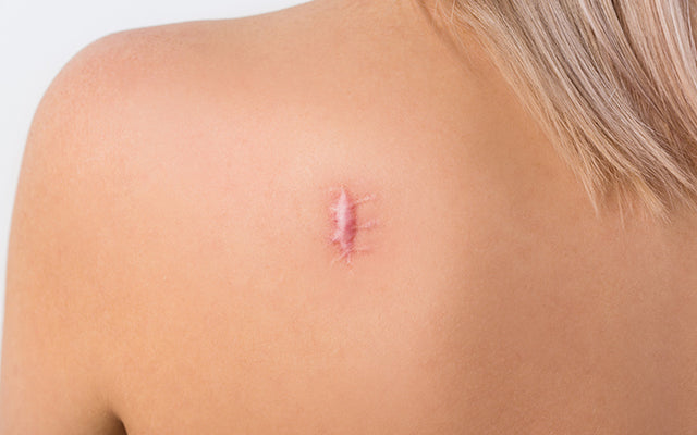 13 Ways To Treat Your Keloid Scars
