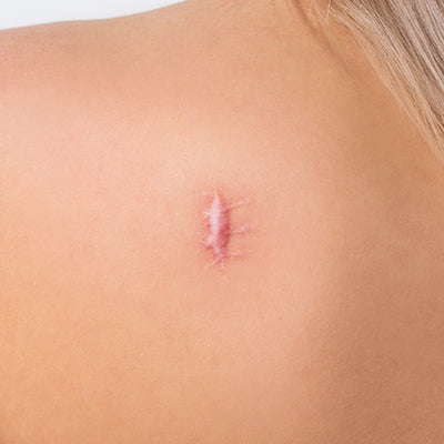 13 Ways To Treat Your Keloid Scars