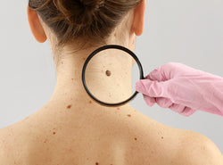 Skin Cancer: Types, Symptoms, Causes & Treatments
