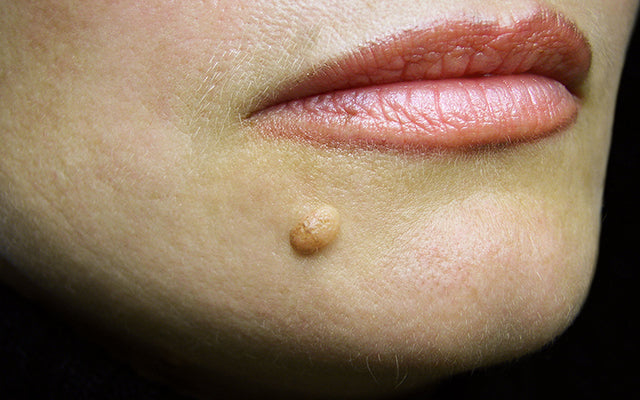 मस्सा के कारण, लक्षण और घरेलू इलाज – Warts Symptoms & Treatment In Hin – SkinKraft