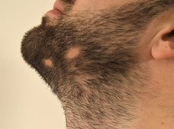 Is Alopecia Barbae Causing Bald Patches On Your Beard?