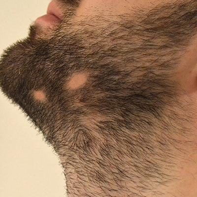 Is Alopecia Barbae Causing Bald Patches On Your Beard?