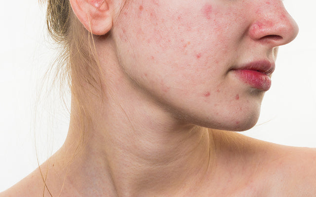 त्वचा पर लाल धब्बे के 10 सामान्य कारण - 10 Common Causes Of Red Spots On Skin