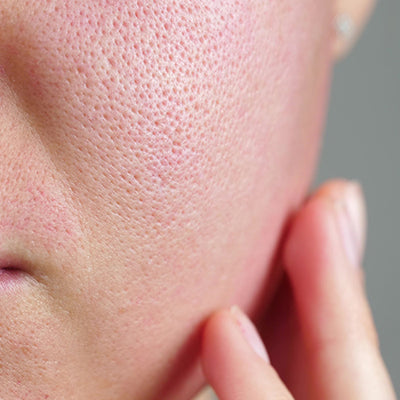 चेहरे के रोम छिद्र बंद करने के उपाय  - Open Skin Pores In Hindi