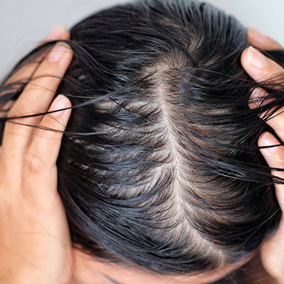 Oily Scalp With Dry Ends: Why & How To Control?