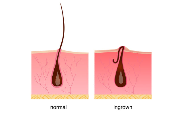 Ingrown hair cyst Treatments causes and prevention