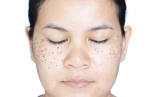 How To Treat And Prevent Scabs On Your Face?