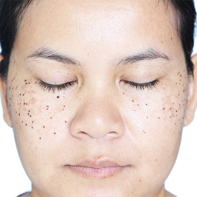 How To Treat And Prevent Scabs On Your Face?