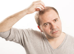 8 Reasons Behind Premature Baldness & How To Treat It