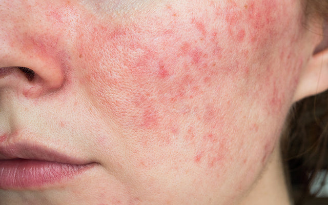 Acne Vulgaris Vs Acne Rosacea: Understanding The Difference