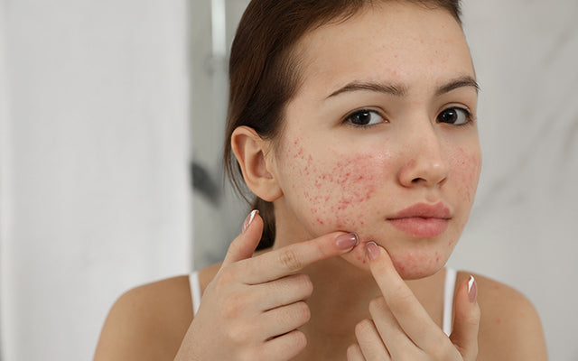 Exploding Infected Pimples All About Infected Pimples And How To Deal With Them – SkinKraft