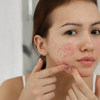 All About Infected Pimples And How To Deal With Them