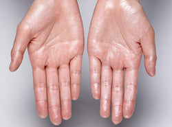 10 Solutions You Need To Treat Sweaty Hands
