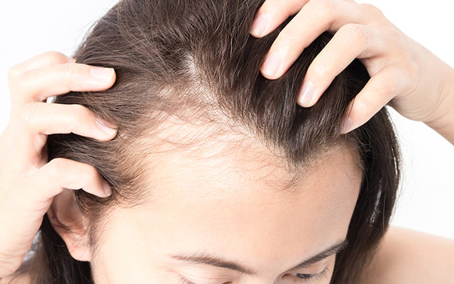 गंजापन के लक्षण, कारण और बचने के उपाय - Hair Baldness In Hindi