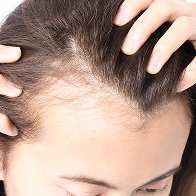 गंजापन के लक्षण, कारण और बचने के उपाय - Hair Baldness In Hindi
