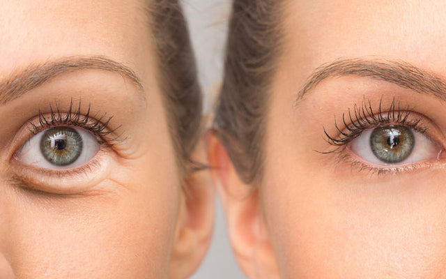 Treat Eye Bags using Light therapy and Lifestyle Changes