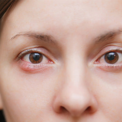 Eye Pimples - Causes, Treatments and Prevention Methods