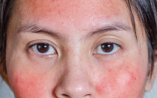 Redness On Face: 15 Causes & 8 Ways To Reduce It