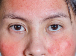 Redness On Face: 15 Causes & 8 Ways To Reduce It