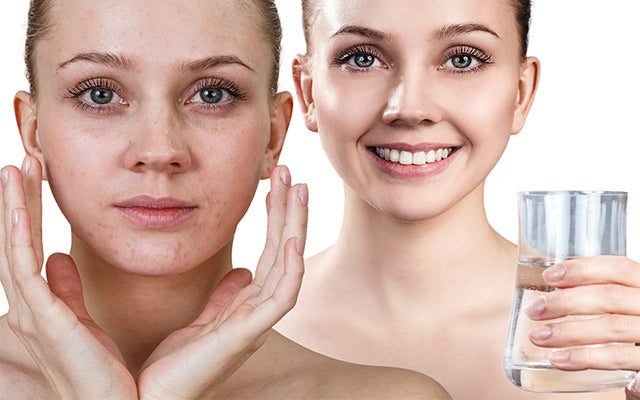 The Best Anti-Acne Drinks To Achieve Glowing Skin